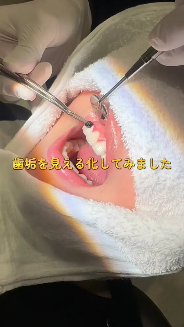 意外と残っている磨き残し🦷
